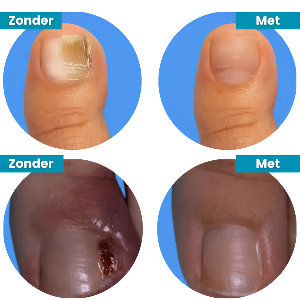 GlowNail™ | Verjong je nagels in 14 dagen - Voor stralende tenen en vingers!